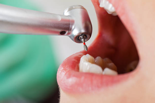 Best Broken or Chipped Tooth Repair in Harlan, IN